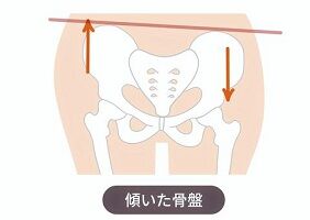 写真 骨盤 傾いた (282x200) に縮小　